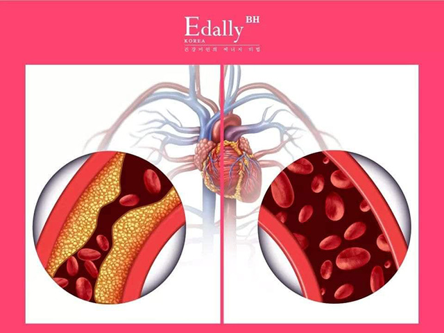 Mỡ máu bám chặt vào thành mạch làm nghẽn mạch. Các cục máu đông sẽ không di chuyển qua được và gây ra đột quỵ